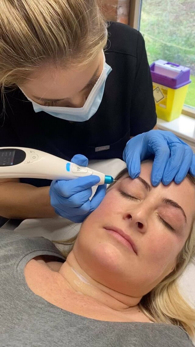 𝙋𝙡𝙖𝙨𝙢𝙖 𝙁𝙞𝙗𝙧𝙤𝙗𝙡𝙖𝙨𝙩..

Our Plasma Fibroblast course comprises of both theory and practical elements on Plasma skin techniques, and has been structured from start to finish with you in mind, to assure that when you complete your training, you will leave with the specialist skills that will help you feel confident to perform Plasma Fibroblast procedures.

𝙔𝙤𝙪 𝙬𝙞𝙡𝙡 𝙜𝙖𝙞𝙣 𝙥𝙧𝙖𝙘𝙩𝙞𝙘𝙖𝙡 𝙚𝙭𝙥𝙚𝙧𝙞𝙚𝙣𝙘𝙚 𝙗𝙤𝙩𝙝 𝙞𝙣 𝙩𝙝𝙚 𝙘𝙡𝙖𝙨𝙨𝙧𝙤𝙤𝙢 𝙖𝙣𝙙 𝙬𝙤𝙧𝙠𝙞𝙣𝙜 𝙤𝙣 𝙡𝙞𝙫𝙚 𝙢𝙤𝙙𝙚𝙡𝙨.

This course is priced at £1599. 

💻 https://tabauk.com/
📧 sales@tabauk.com
📞 0151 345 6597

#fibroblast #plasmapen #skincare #plasmafibroblast #skintightening #fibroblastskintightening #beauty #plasma #plasmalift #microneedling #fibroblastplasma #microblading #antiaging #fibroblasting #skin #prp #lips #brows #plasmaskintightening #lipfiller #bbglow #skinrejuvenation #antiwrinkle #dermaplaning #facial #botox #fibroblasttraining #wrinkles #skinneedling #hifu